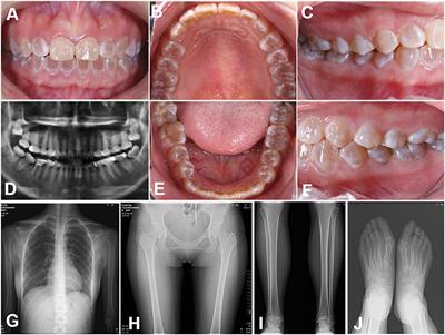 Case Report: A Novel COL1A1 Missense Mutation Associated With Dentineogenesis Imperfecta Type I